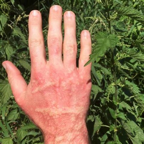 How To Recognize and Treat a Stinging Nettle Rash