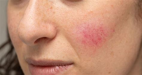 Pele Do Rosto Descascando E Vermelha - Manchas vermelhas na pele: 8 causas comuns e o que fazer