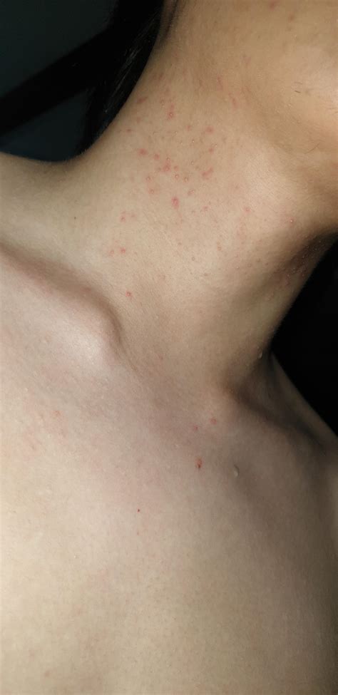 What are these small red bumps on my neck and how to cure it? : r/skin