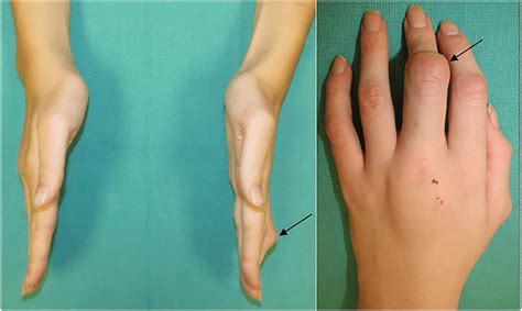 conceptual framework  assessing  rheumatoid patient  hand