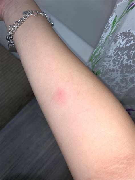 Faster skin tests will replace the need for photos of a positive tb test 32