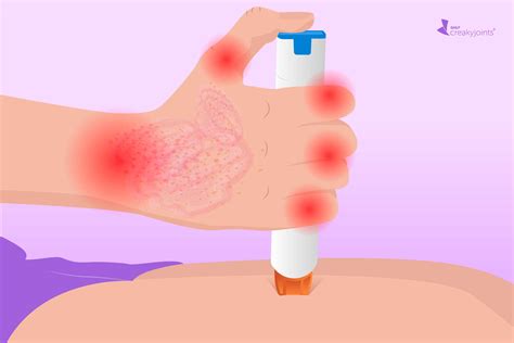 Browse All Psoriatic Arthritis Resources – CreakyJoints