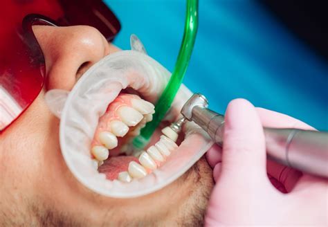 Know more about dental deep cleaning technique - Teeth Scaling - DentalDost