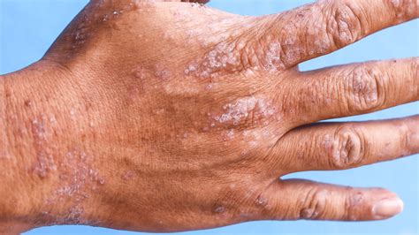 Types of Eczema: Contact Dermatitis | Gladskin