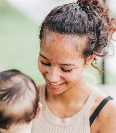 accutane birth defects photos 3