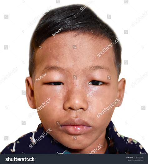 Periorbital Edema Nephrotic Syndrome