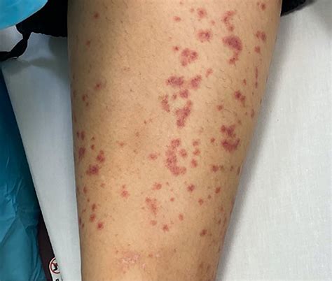 Maculopapular Rash Pictures Causes Treatment