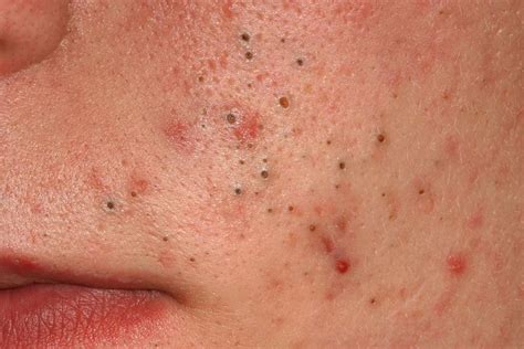 types  pimples    tackle