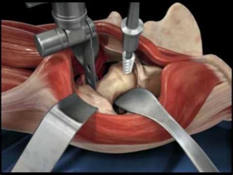 The pros and cons of anterior hip replacement surgery