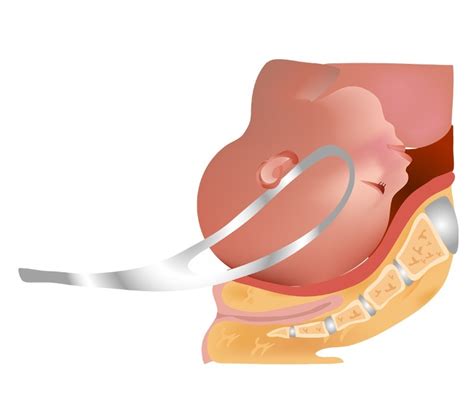 O Que É Parto Forceps - Parto Fórceps – Guia do Bebê