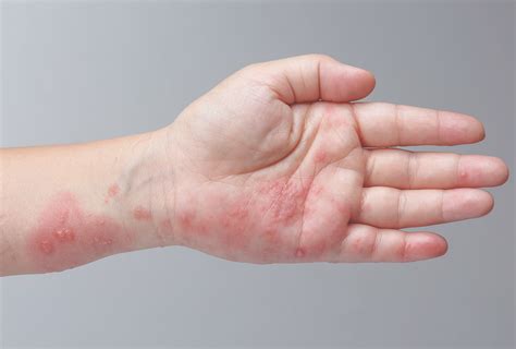 Scabies: Causes, Symptoms, Treatment, & Complications