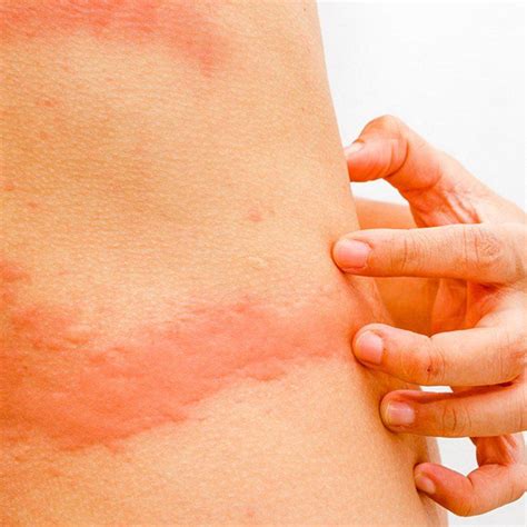 What s that rash on your body 5 common types explained – Artofit