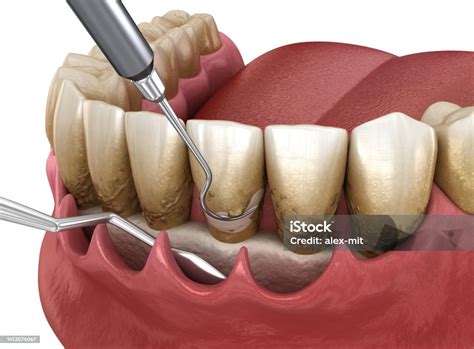 Como É O Procedimento De Curetagem - Foto de Curetagem Aberta Dimensionamento E Planejamento Radicular ...