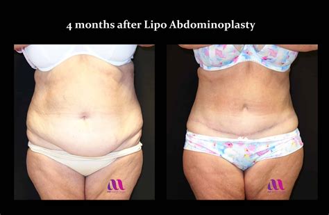 Abdominoplasty / Tummy tuck / Repair of post pregnancy split in