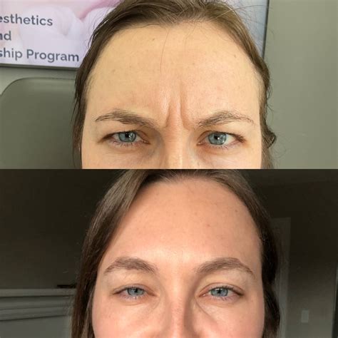 frown line still there after botox 8