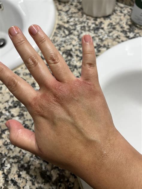 itchy red hands, allergic reaction ? : r/skin