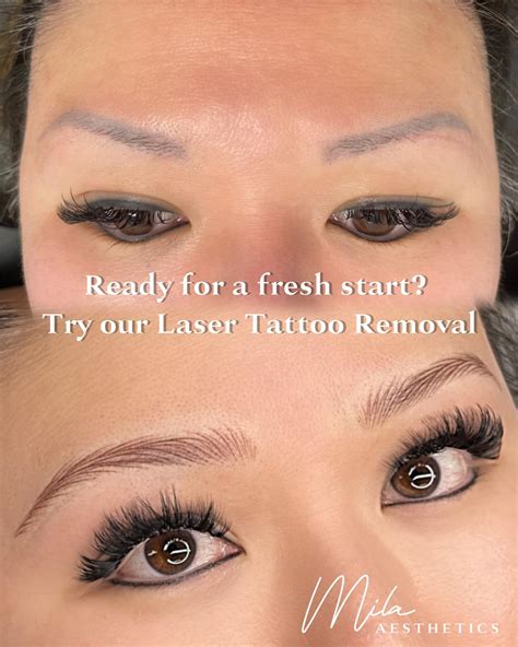 laser tattoo eyebrow removal 11