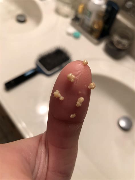 how to get popcorn kernel out of tonsil 5