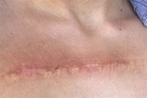 stages  wound healing  timeline   process