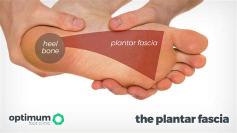 Plantar Fasciitis - Heel Pain Explained - Optimum Foot Clinic