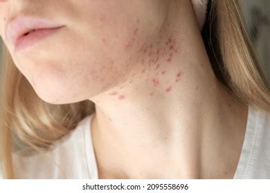 2,507 Neck acne Images, Stock Photos & Vectors | Shutterstock