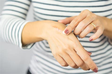 Atenuar las cicatrices con crema cicatrizante | Cocooncenter®