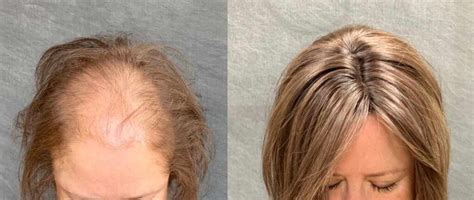 how to cover thinning hair for women
