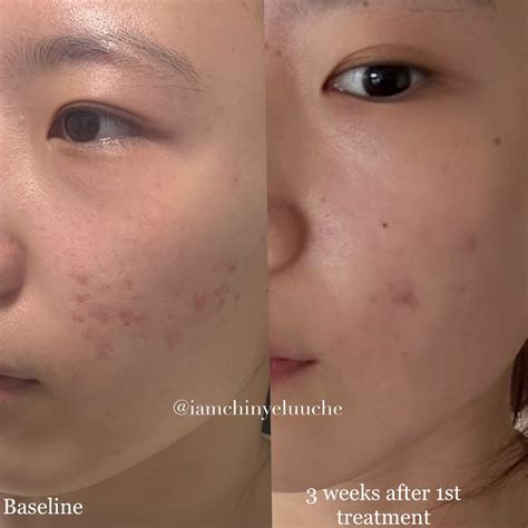 Everyday Skin Clinic | Treatment Gallery