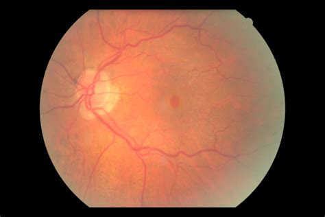 trou maculaire sevision