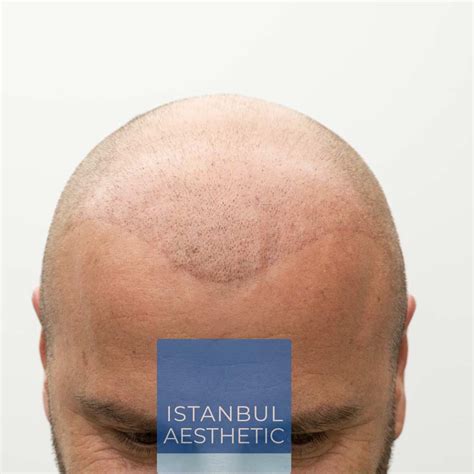 FUE Hair Transplantation – Istanbul Aesthetic Center