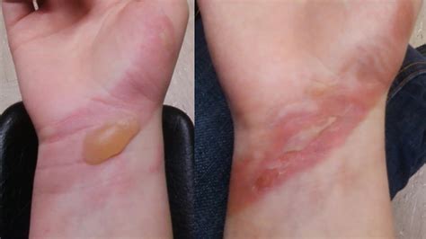 Wonderful Tips About How To Recover From Burns - Servicecomplex10