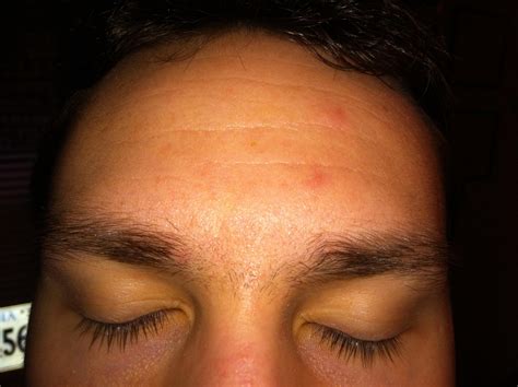 Pityrosporum Folliculitis