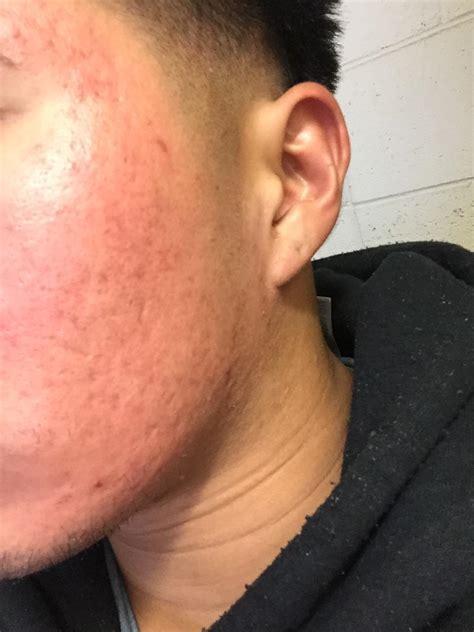 face  red        rid   rosacea facial