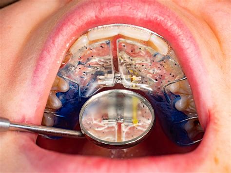 palatal expander face change 8