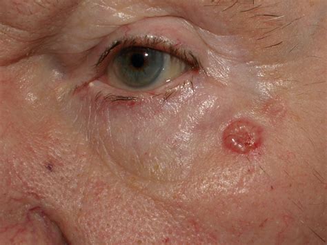 Images Of Basal Cell Skin Cancer