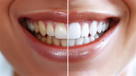 Teeth Whitening in Turkey | Avicenna Hospital