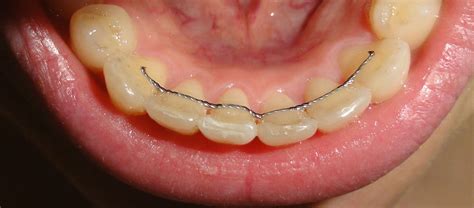 fixed orthodontic retainer