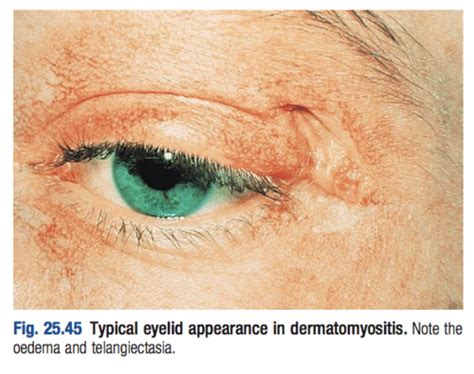 Idiopathic inflammatory myopathies Flashcards | Quizlet