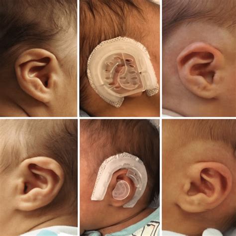 Earwell Newborn Ear Molding | Summit, NJ