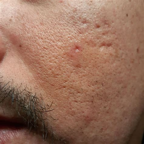 Help! Severe acne scars – Scar treatments – Acne.org Forum