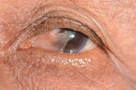 pterygium surfers eye symptoms  treatment lions eye