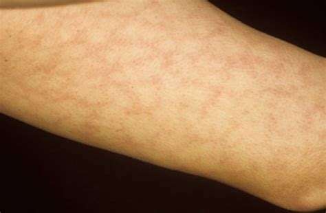 livedo reticularis rash - pictures, photos