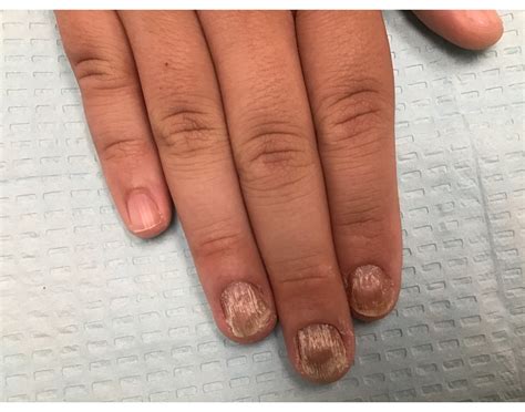 Nail Psoriasis — Dr. Dana Stern | Dermatologist | Nail Specialist