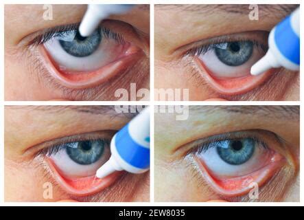 Implementation drug in conjunctival sac. Instill eye ointment Stock ...