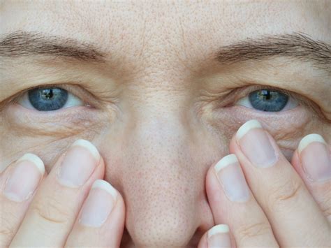 correcting drooping eyelids   vision emilio  justo md