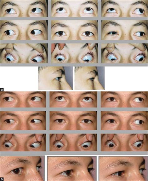 Duane syndrome, Duane Retraction syndrome causes, diagnosis & treatment