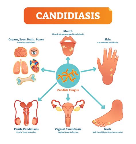 Candidiasis: causas, síntomas y consejos - Blog de Naturlíder : Blog de
