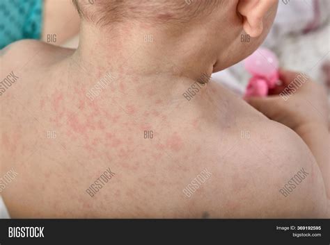 roseola rash viral image photo  trial bigstock