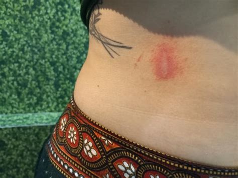 Bug bite? Rash? : r/VietNam