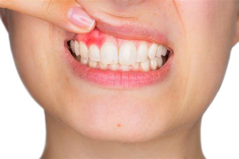 Bleeding Gums: 9 Major Causes and Remedies | Gentle Dental